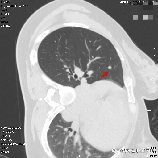 叶建明谈实性结节,叶建明肺实性良性结节会变癌症吗