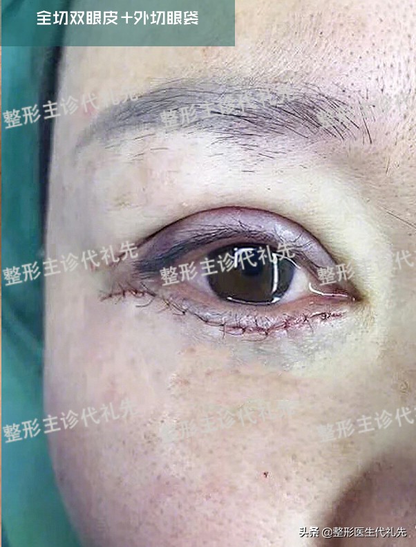 新月双眼皮怎样改扇形,聊双眼皮话术