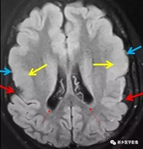影像学脑室扩大,脑室显大怎么理解