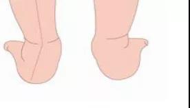 什么是扁平足？日常生活要怎样预防呢？