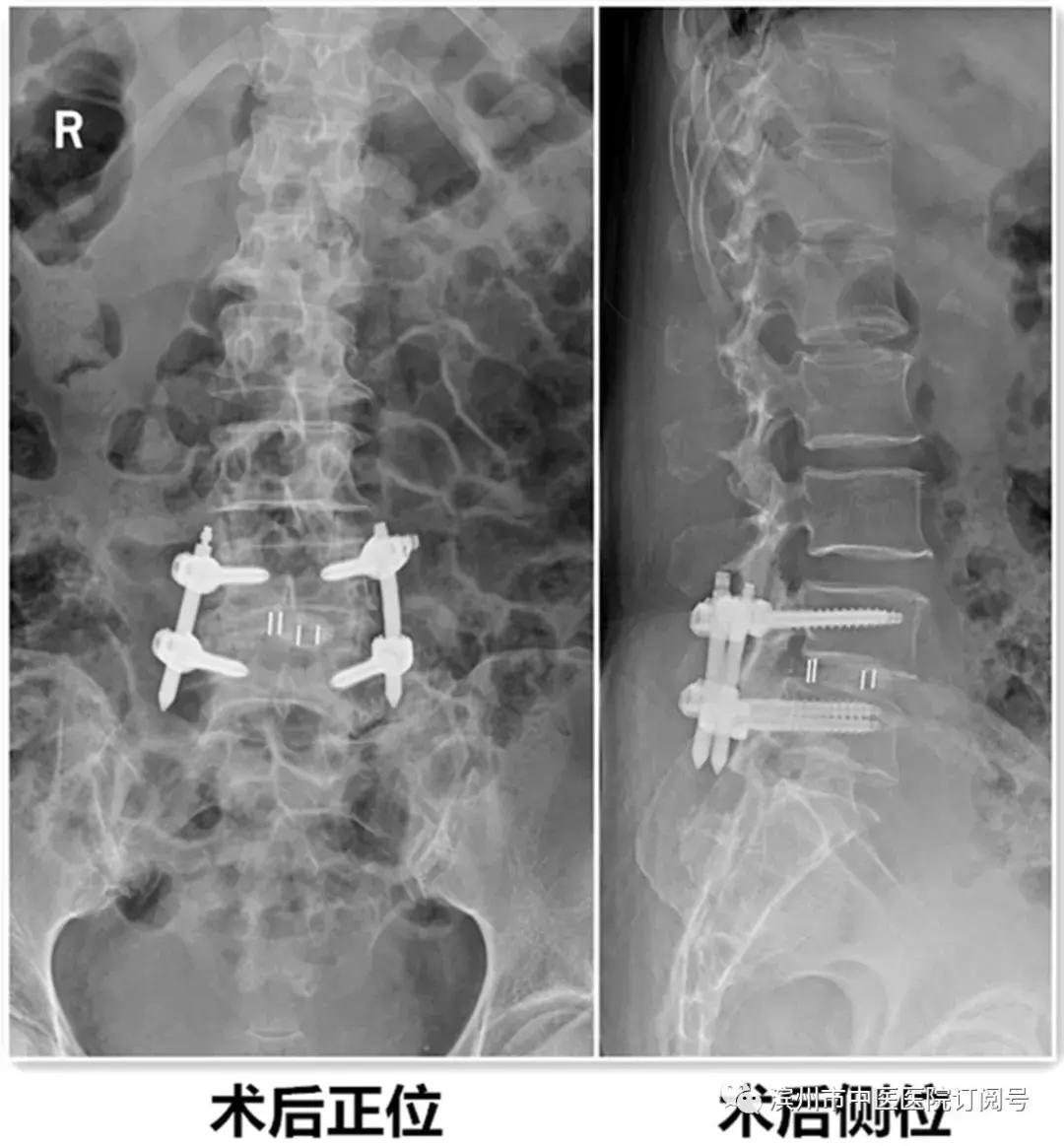 椎间盘突出保守治疗,椎间盘治疗视频大全