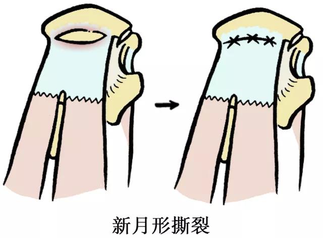 肩伤如何练肩,骨科专家教你肩袖康复训练