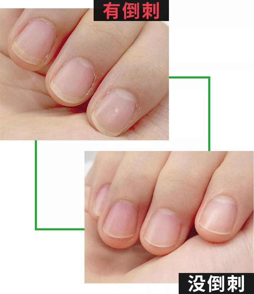 擦手霜保湿干裂起皮,冬季手干裂粗糙小妙招