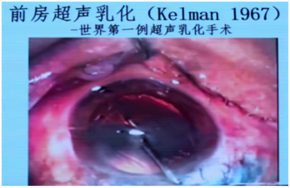 白内障手术技术历程,专家讲解白内障手术的重难点