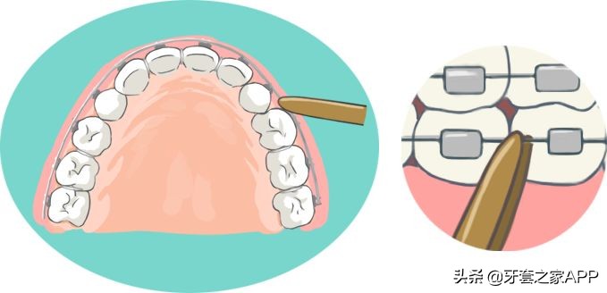 疫情时牙套遇到突发情况怎么办？应对办法在这里