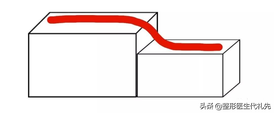 拉皮五天没消肿法令纹还在,拉皮手术可以去除法令纹吗