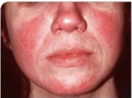 痘痘反反复复教你一招祛痘不再难,为了祛痘曾经你试过哪些方法