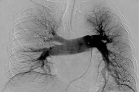 举例科普|介入能治疗哪些疾病?