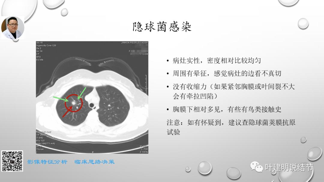 叶建明谈肺实性小结节视频,廖正银教授谈肺结节