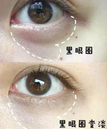 去眼纹去黑眼圈用什么方法,去眼袋黑公认最好用的土方法