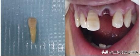 牙齿磕掉了怎么办幼儿园,6岁牙齿磕掉了怎么办