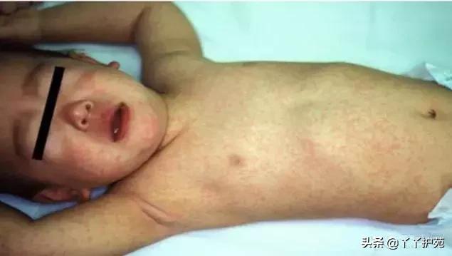 儿科常见出疹性疾病,儿科常见出疹性疾病有哪些