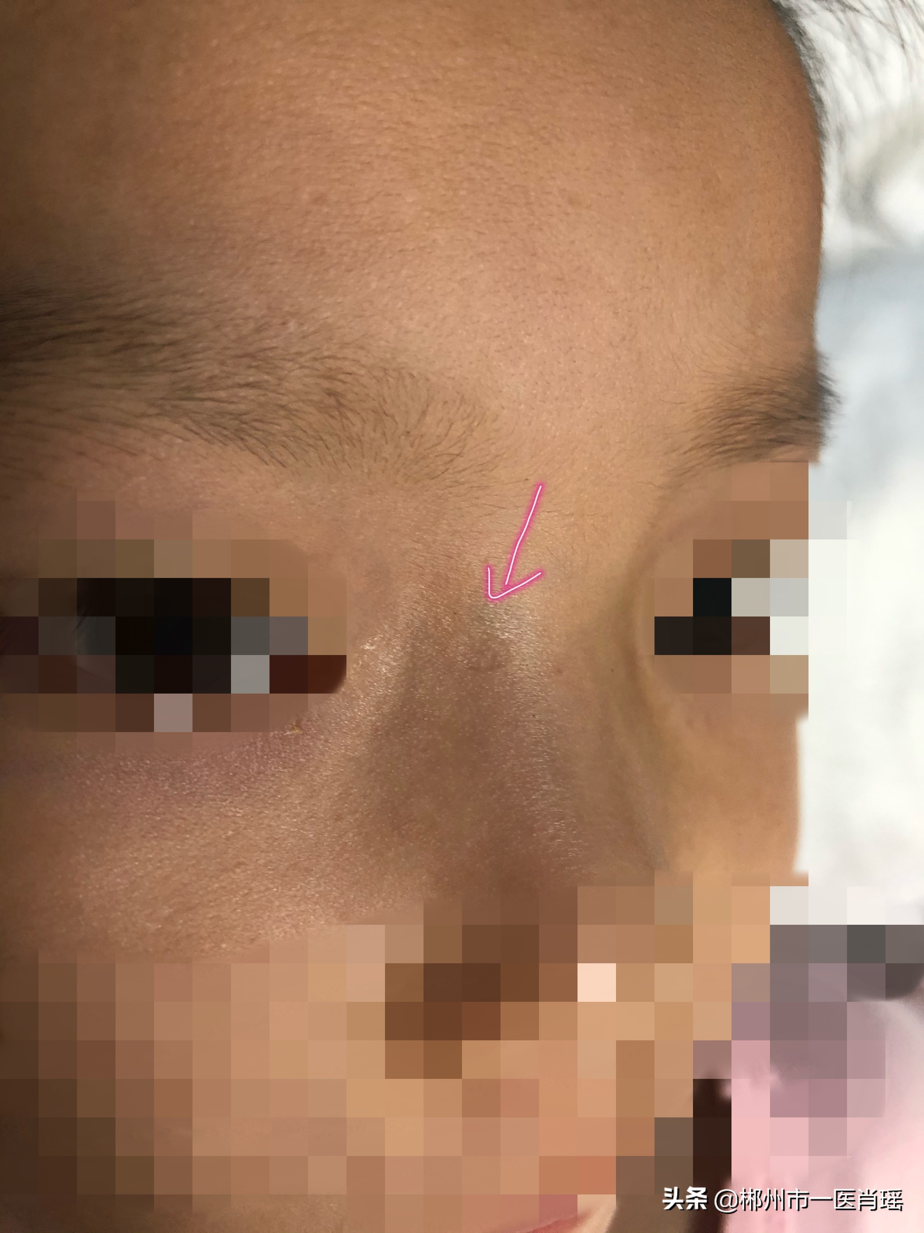 点痣留下的凹坑用点阵激光,为什么激光点痣会留疤