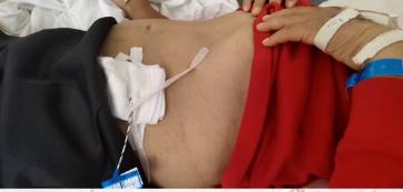 徐州医科大学附属医院布加综合征,布加综合征临床试验