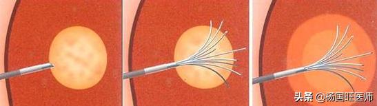 医学科普肿瘤细胞,医学科普怎样进行肿瘤热疗
