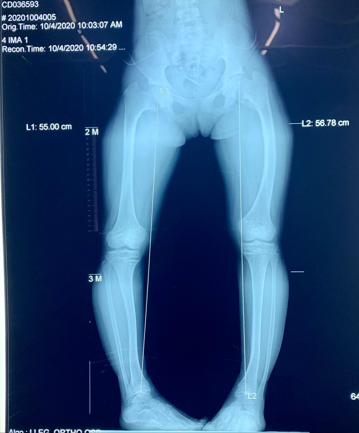 运动足外翻怎么矫正,运动引起脚大拇指外翻怎么矫正