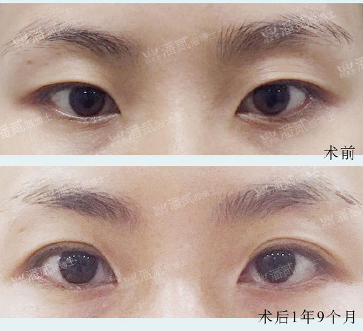 我想做个双眼皮,上睑下垂做了提肌双眼皮