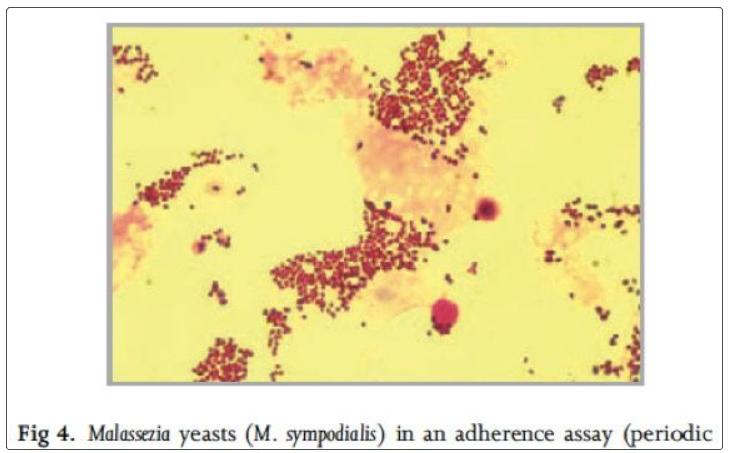 头屑多掉头发严重什么原因,头屑多掉头发是什么原因
