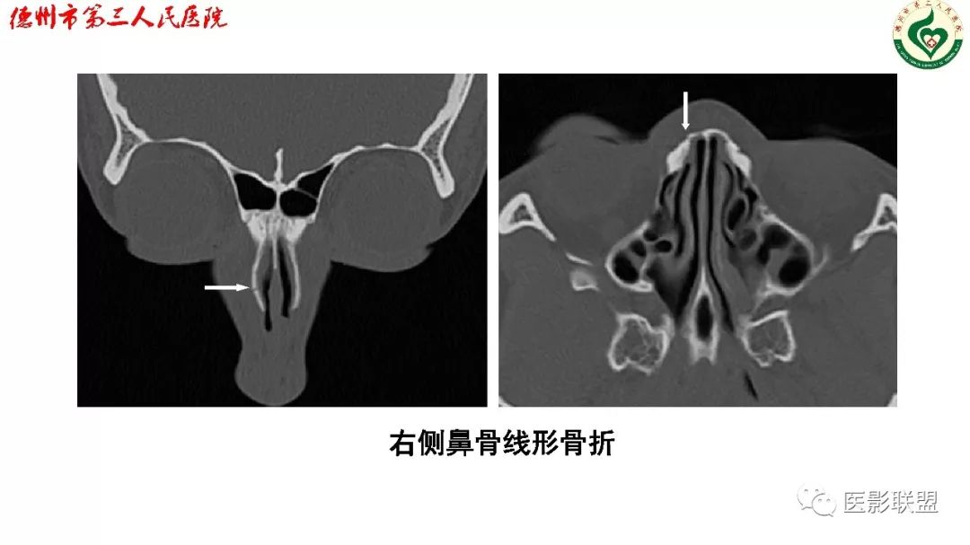 鼻骨骨折影像,鼻骨骨折dr影像表现