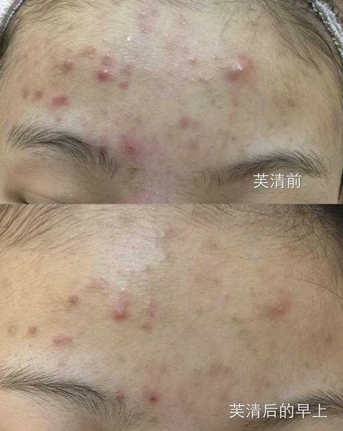 医美面膜大合集教你怎么选,烂脸救星来了最近大火的医美面膜