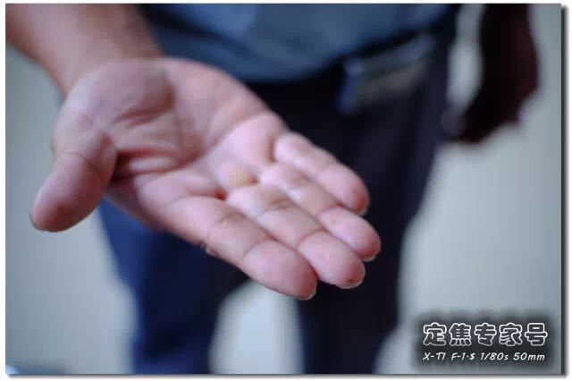 肠道息肉嘴唇黑斑,嘴唇上有黑点是肠道息肉吗