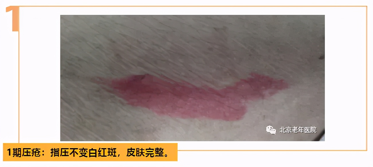 老年人防压疮的饮食照护原则,三度压疮老年人的家庭照护