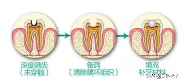 补过的牙几年后突然又疼了怎么治,补了几年的牙突然疼痛要如何解决