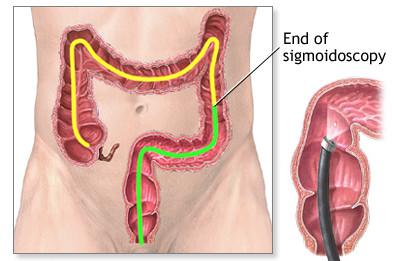 14个月宝宝肠套叠是什么症状,肠套叠的三大典型症状肠胀气