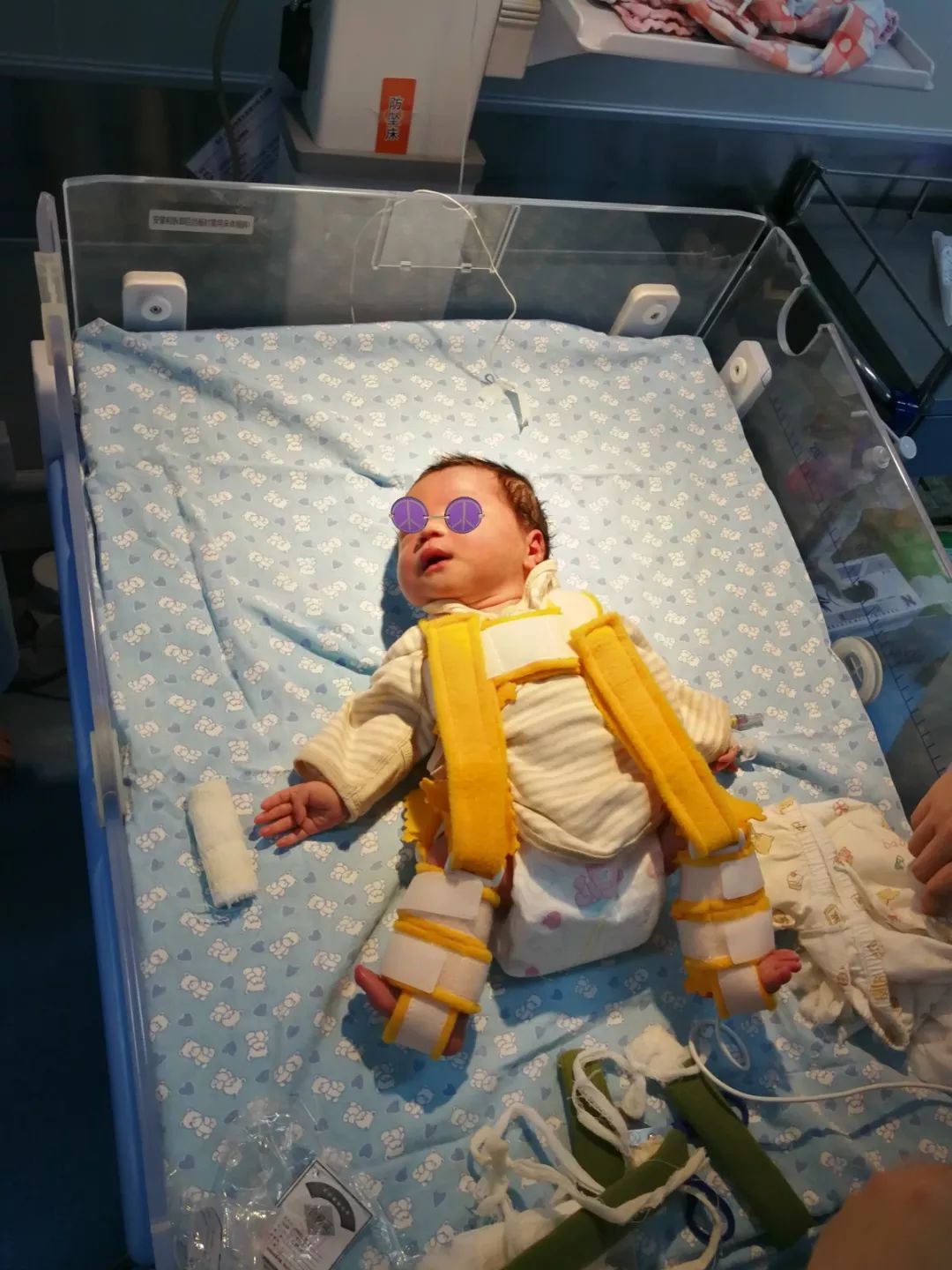 婴儿股骨骨折会有后遗症吗,六个月婴儿右股骨骨折