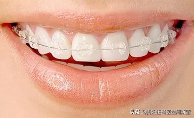 三种牙套大PK，优势对比一目了然