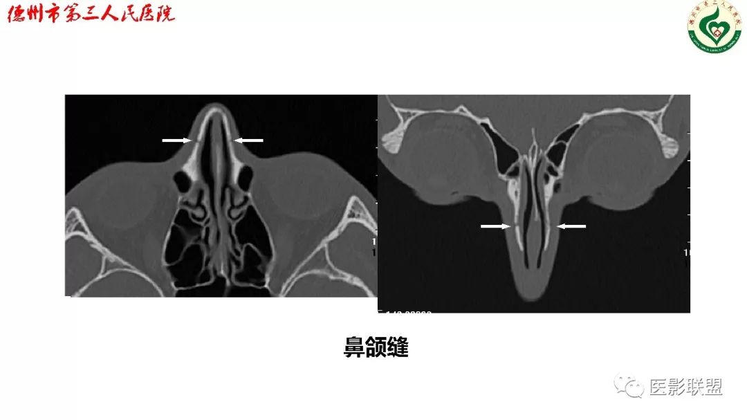 鼻骨骨折dr影像表现,鼻骨骨折影像学诊断