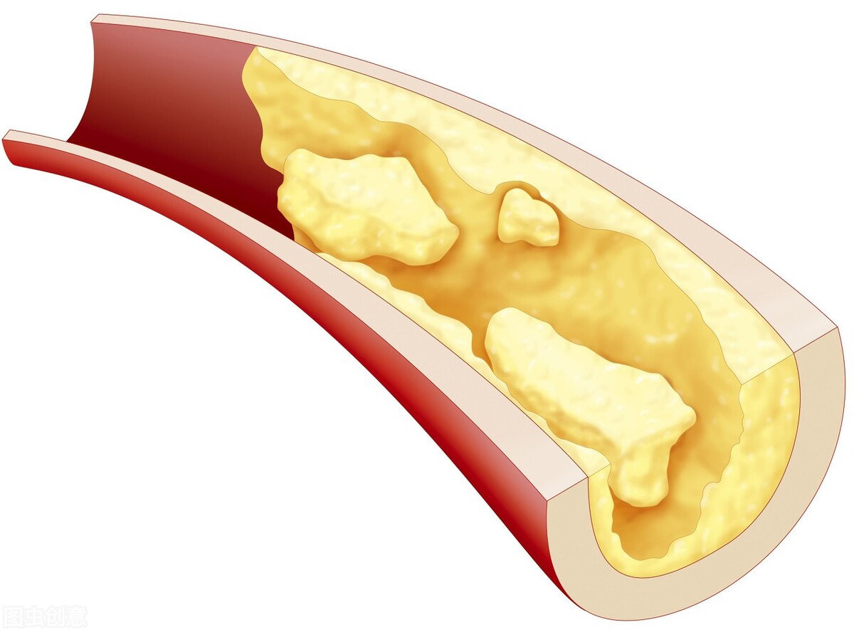 老年人输液通血管的药好吗,老年人输液疏通血管有必要吗
