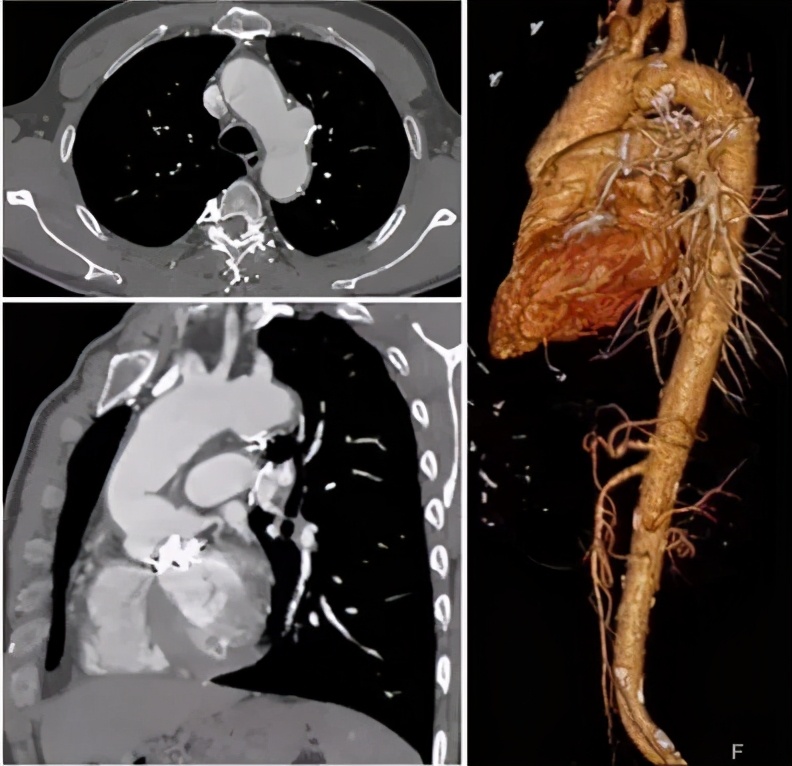 胡佳:升主动脉近端手术后新发弓部病变的腔内治疗