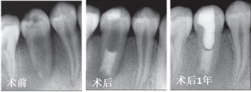牙髓坏死还做根管治疗吗,牙髓坏死了需要取出来吗