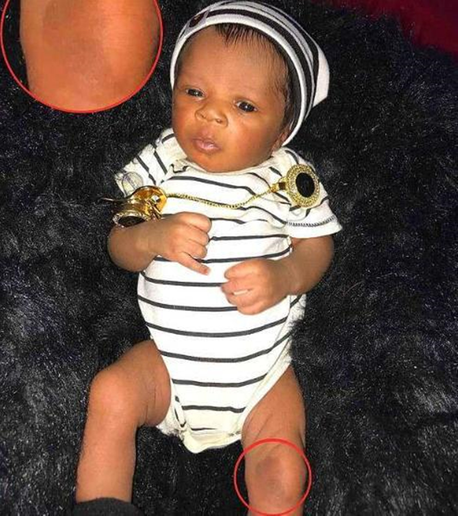 龙凤胎姐姐腹中被“吸收”，弟弟出生后腿上胎记引关注，让人动容