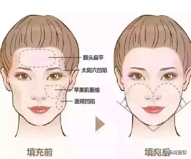 科普：自体脂肪面部填充有哪些优缺点、有哪些风险呢？