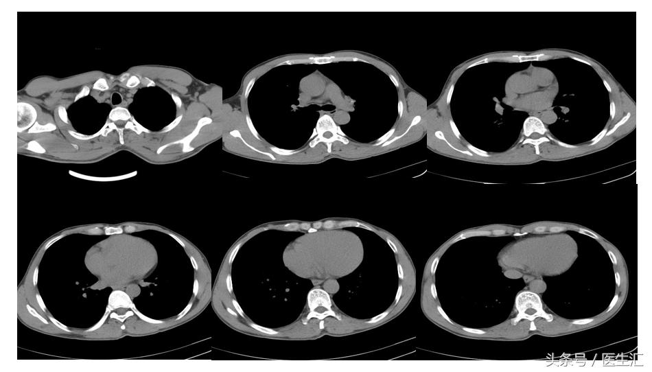不小心吸入水泥粉末怎么办,吸入水泥粉末怎么办