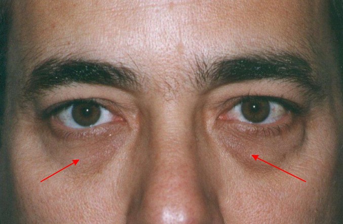 有黑眼圈可以吃补肾补肝的药吗,老中医治黑眼圈偏方