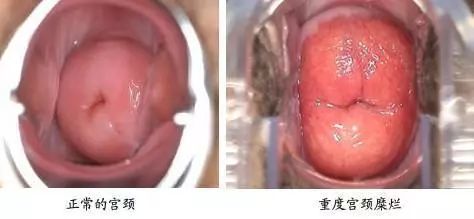 宫颈糜烂每个女人都有吗,女人宫颈糜烂服些什么药