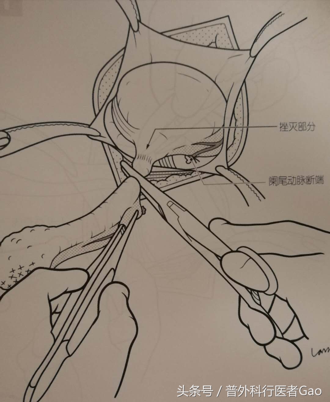 鏉忎粊鑳芥不闃戝熬鐐庡悧,鏉忎粊鍒囬櫎