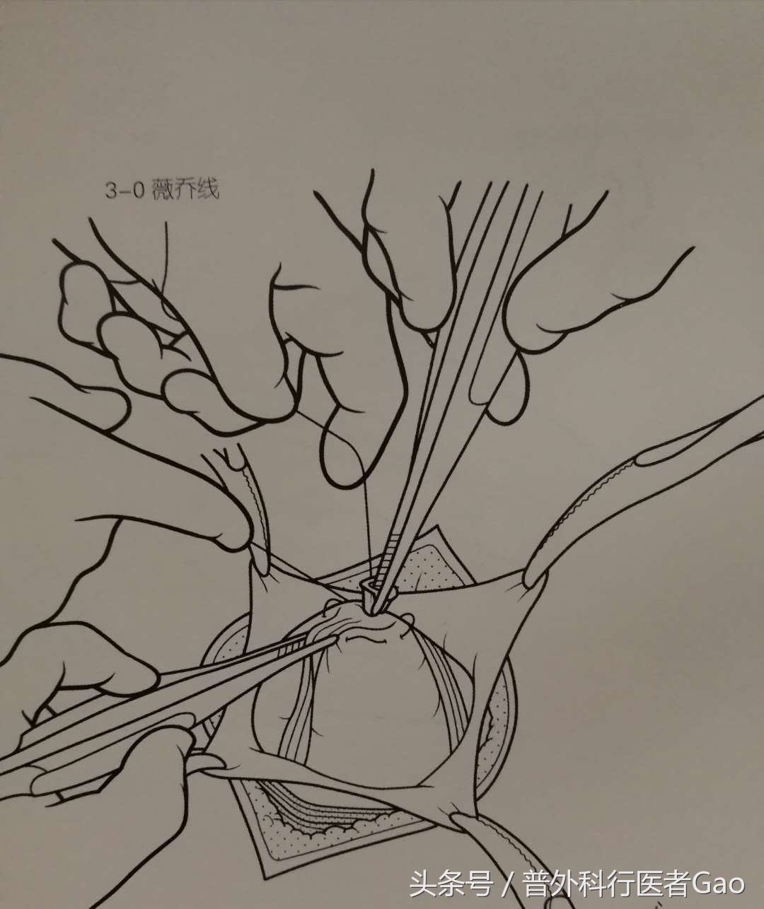 杏仁：一图一话全面解析阑尾的切除过程（干货，不懂医也学习了）