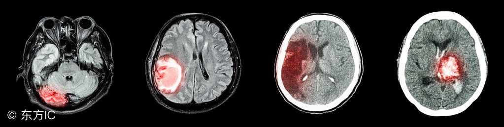 脑堵塞和脑出血哪个严重,脑溢血和脑血栓症状有什么区别