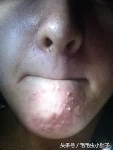 痘痘肌的处理及应对方法,痘痘大作战有没有秘籍