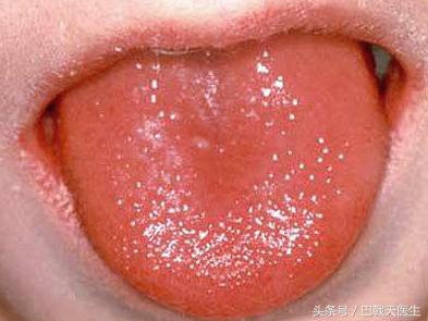 孩子出疹子宝妈需要忌口哪些,宝妈身上起疹子怎么办