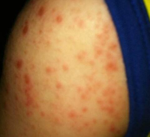 过敏性湿疹能用母乳涂抹吗,过敏性湿疹和母乳有关系吗