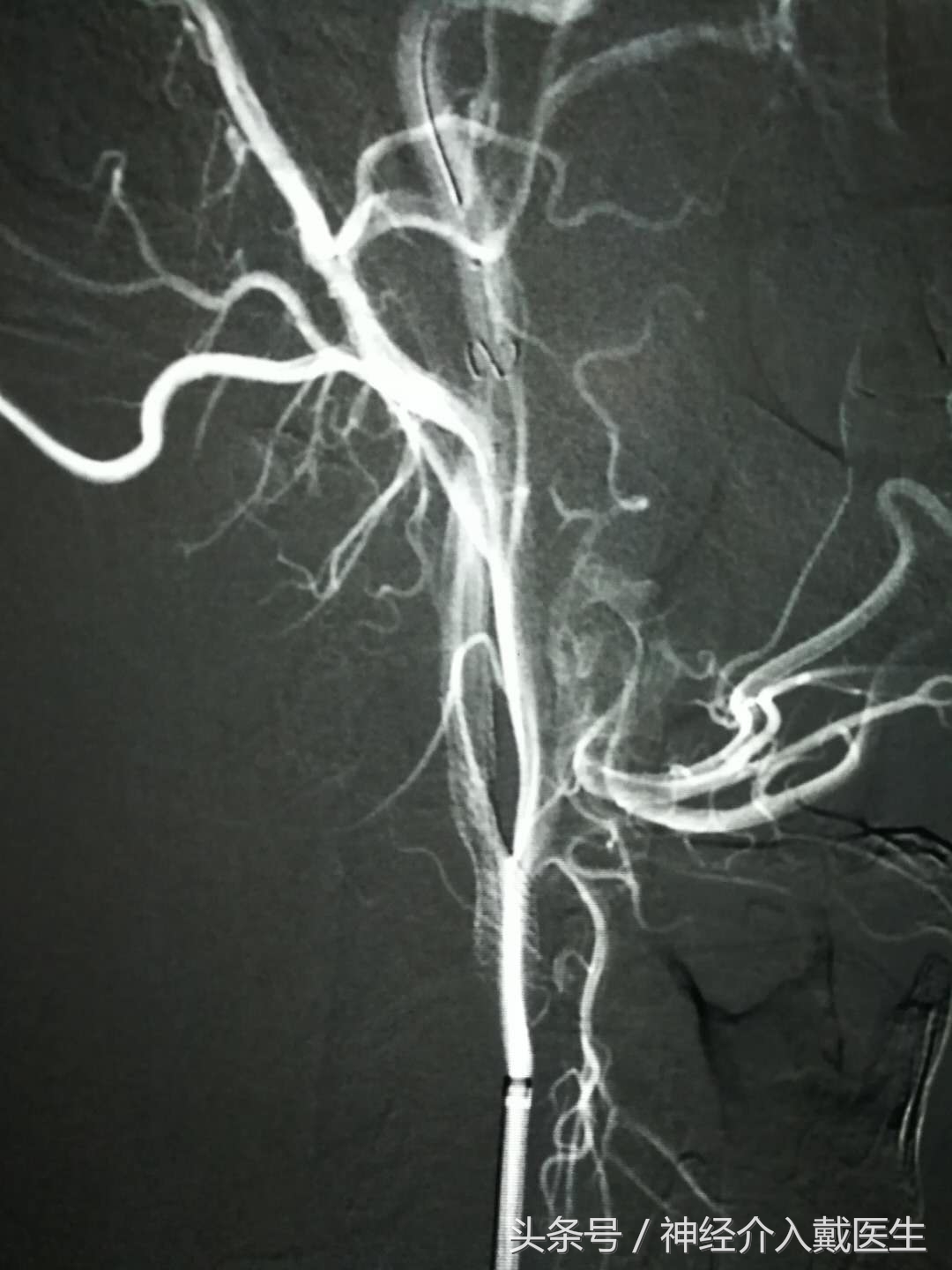 脑血管畸形介入手术是放支架吗,脑部血管支架介入手术风险大吗
