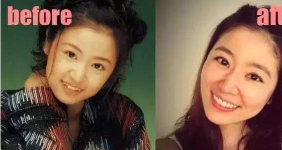 高圆圆戴牙套前后对比,高圆圆牙齿矫正牙套戴了几年