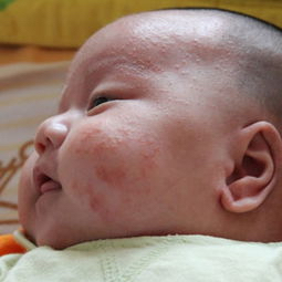 宝宝出现湿疹怎么办,宝宝的湿疹反反复复的怎么办