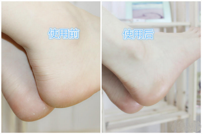 脚裂个口子总是不愈合,脚跟裂怎么办