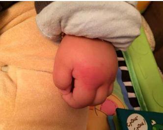 婴儿手指尖突然红肿,3岁宝宝手突然肿的像馒头怎么办